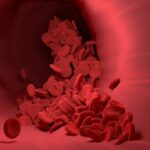 Penyumbatan Aliran Darah ke Otak, Penyebab Stroke Iskemik